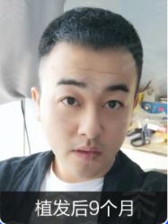 -雍禾植发