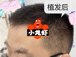 -大麦微针植发全国连锁