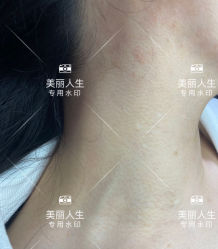 -爱莎扁平疣·汗管瘤·斑痣中心