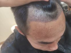 -碧莲盛·不剃发植发