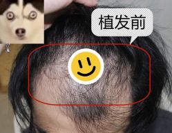 -大麦微针植发全国连锁