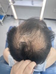 -大麦微针植发全国连锁