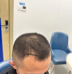 -大麦微针植发全国连锁