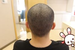 -大麦微针植发丨全国连锁