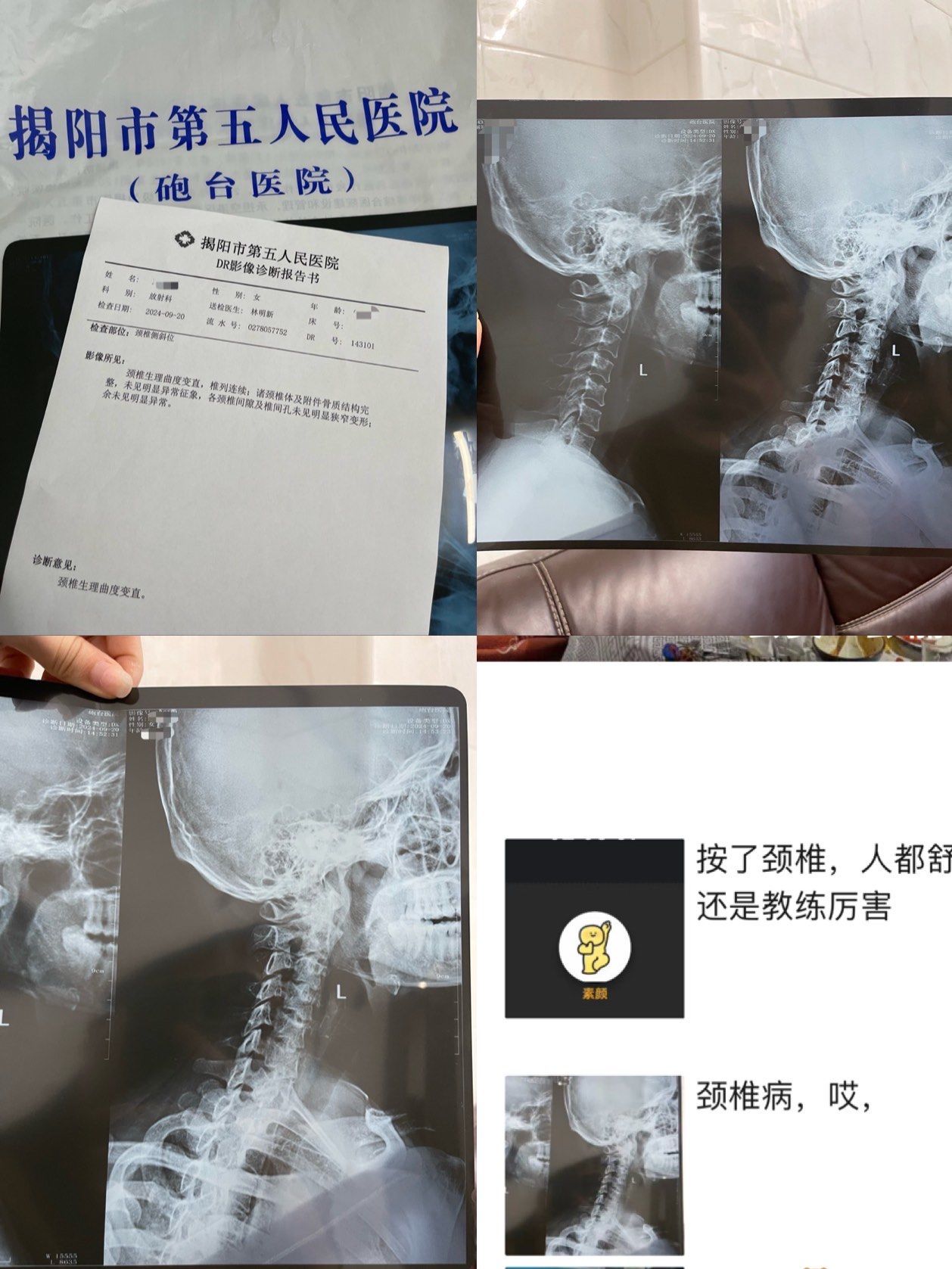 颈椎生理曲度变直,大部分是生活习惯不良引