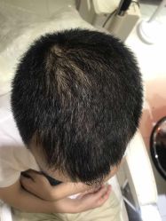 点击看大图 -大麦微针植发全国连锁