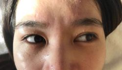 -爱莎扁平疣·汗管瘤·斑痣中心
