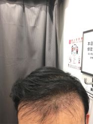 -碧莲盛·不剃发植发