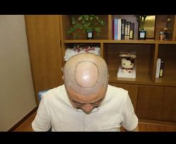 体验前-大麦微针植发全国连锁