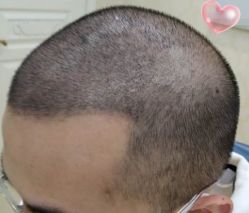 -大麦微针植发丨全国连锁