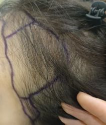 -碧莲盛·不剃发植发