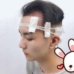 -大麦微针植发丨全国连锁