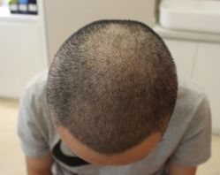 -大麦微针植发丨全国连锁