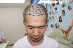 -大麦微针植发丨全国连锁