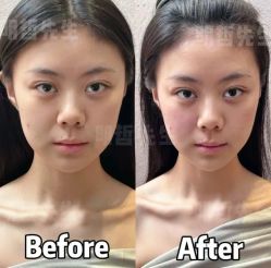 -颜和骨正&明星徒手小颜整骨