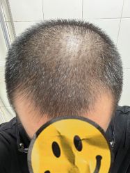 体验前-大麦微针植发全国连锁