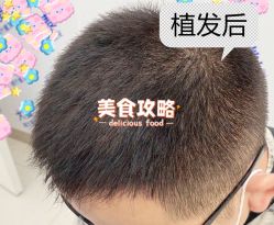 -大麦微针植发全国连锁