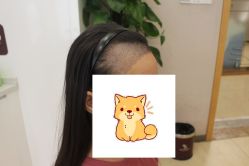 -大麦微针植发丨全国连锁