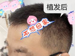 -大麦微针植发全国连锁