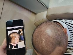 -碧莲盛·不剃发植发