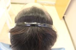 -大麦微针植发丨全国连锁