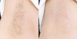 -小梨·OndaPro·专业脱毛连锁机构