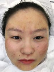 -悟空祛痘·诺奖技术专业店