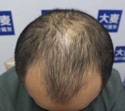 体验后-大麦微针植发丨全国连锁
