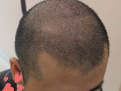 -大麦微针植发丨全国连锁