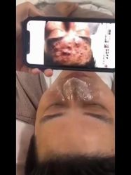-瑶芳清颜草本祛痘