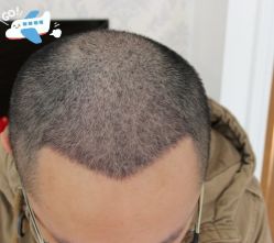 -大麦微针植发丨全国连锁