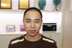 -大麦微针植发丨全国连锁