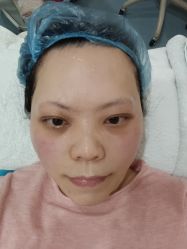 体验后-郡艺医疗美容·微整·眼鼻吸脂