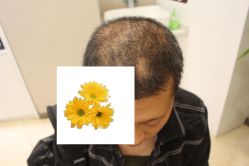 -大麦微针植发丨全国连锁