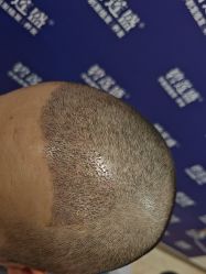 -碧莲盛·不剃发植发