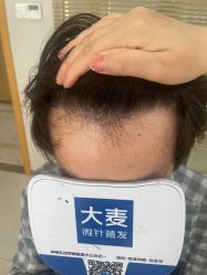 -大麦微针植发丨全国连锁