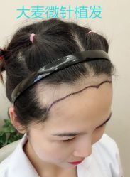 -大麦微针植发丨全国连锁