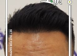 -大麦微针植发全国连锁