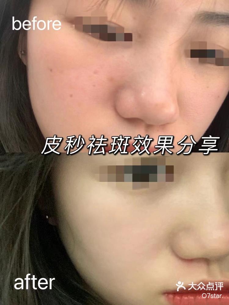 在医生的建议下我做了超皮秒, 刚开始还是会担心做了之后效果不好