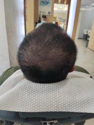 体验后-大麦微针植发丨全国连锁