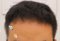 -大麦微针植发全国连锁