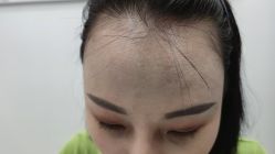 -大麦微针植发全国连锁