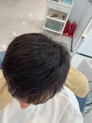 -大麦微针植发丨全国连锁
