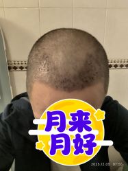 -大麦微针植发全国连锁