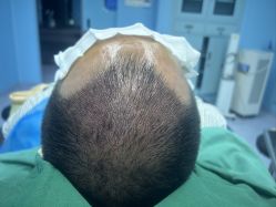 体验后-大麦微针植发全国连锁