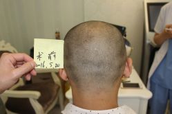 -大麦微针植发丨全国连锁