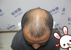 -大麦微针植发丨全国连锁