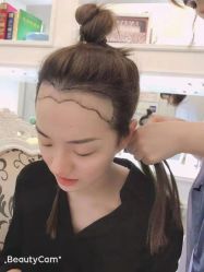 -大麦微针植发丨全国连锁