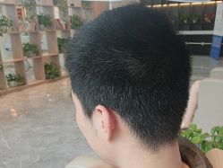 -碧莲盛·不剃发植发