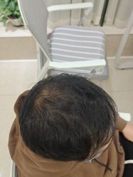 点击看大图 -碧莲盛·不剃发植发